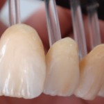 IPS Emax Crowns